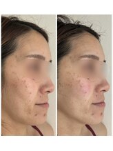 ルアンビューティー メディカルプラス(Luan beauty MEDICAL+)/チタニウムリフト×1回