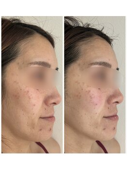 ルアンビューティー メディカルプラス(Luan beauty MEDICAL+)/チタニウムリフト×1回