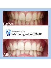センス(SENSE)/Before＆Aｆter　ホワイトニング