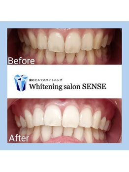 センス(SENSE)/Before＆Aｆter　ホワイトニング