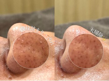 スー 千種 今池(Suu.)/韓国式毛穴洗浄"アクアピール"