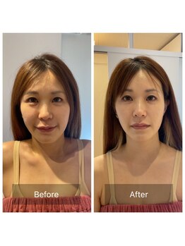 サンサンゴビューティー(335beauty)/リブセラ/施術回数1回