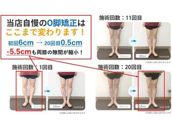 むね整体院 カナザワ(KANAZAWA)の写真/【6/29～7/4限定】昔からのO脚・X脚でお悩みの方☆美脚改善☆初回3,980円→