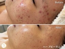プリュボーテ(Pul Beaute)/しつこいニキビ対策を早急にケア
