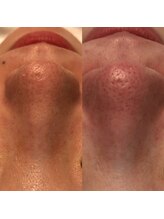 ナラビューティー(NARA BEAUTY)/毛穴コース