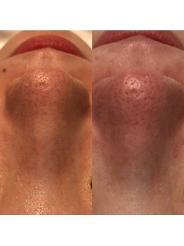 ナラビューティー(NARA BEAUTY)/毛穴コース