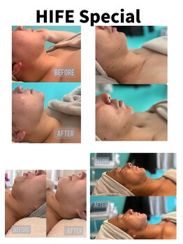 トータルビューティーアンドウィズ(total beauty&WITH)/たるみケア、小顔効果Special