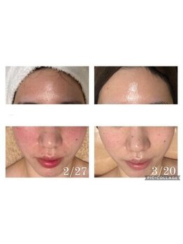 オアジスパ(Oasi Spa)/グリーンピール1Day