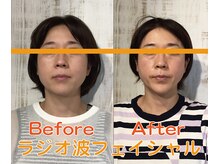 オフェリア(Ophelia)/ラジオ波フェイシャル結果