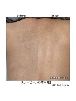 ルナ(Runa)/スノーピールのビフォーアフター