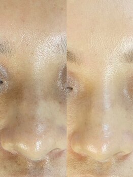 ユウビ ビューティー サロン(Yuubi)/【peel stage】ハーブピーリング