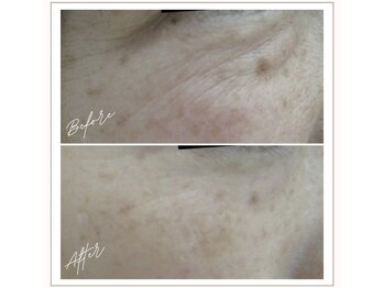 ミューベル(MYubelle)/エイジングケア 水光ピーリング