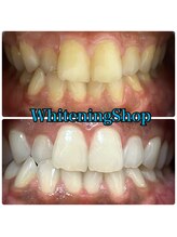 ホワイトニングショップ 山形店(Whiteningshop)/ホワイトニングで一息