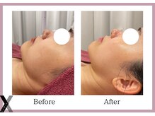 クロス(Xcross)/ララピール【フェイシャル】