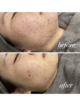 ニコサロン(25salon)/ハーブピーリング