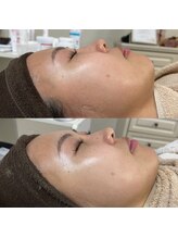 ココ(COCO)/Revi陶器トリートメント