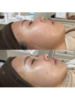 ココ(COCO)/Revi陶器トリートメント