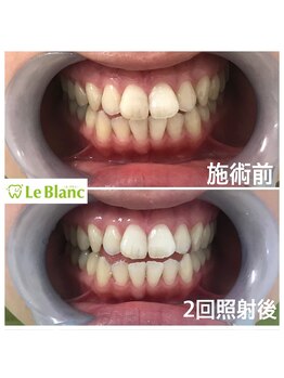 ルブラン 奈良店(Le Blanc)/ブライダル前に欠かせない