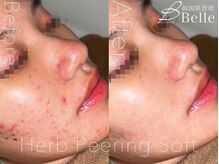 ベル 博多(Belle)/ ハーブピーリング｜ニキビケア