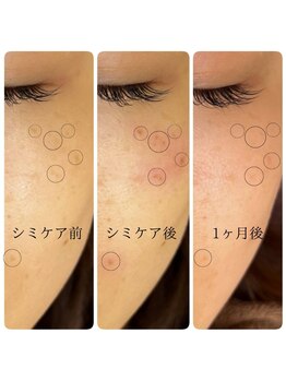 ギルドハナレ(GUILD HANARE)/"目立つシミを薄く"