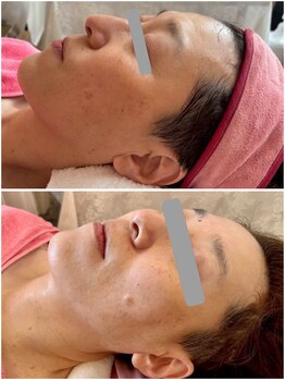 ラシック/ララピール　1回目→5回目