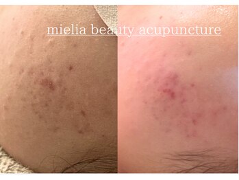 ミエリア美容鍼灸院(mielia美容鍼灸院)/ニキビや赤みのある毛穴肌