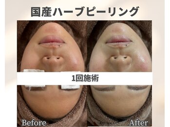 イーラボ 池袋店(e-LABO)/大人気!国産ハーブピーリング