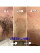 シャレールオム(Chareir Homme)/ワキ脱毛 初回～３週間毎の変化