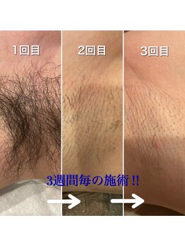 シャレールオム(Chareir Homme)/ワキ脱毛 初回～３週間毎の変化