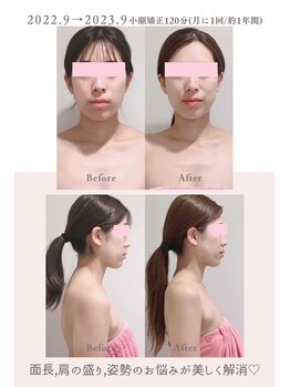 トゥインクル 麻布(twinkle)/麻布十番/シンメトリー小顔矯正