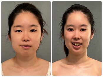 カナエルサロン 旭川(KANAERU SALON)/【小顔ケア】症例☆