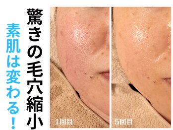 エリン(ERIN)/レチノールピール