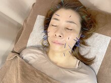 こじま 富雄団地接骨院/ベーシック美容鍼