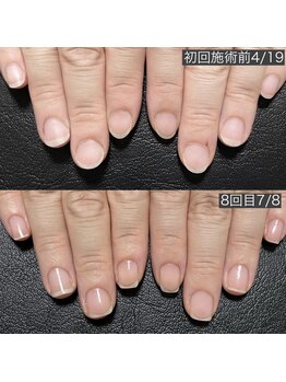 自爪育成ネイルケア