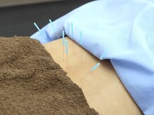 とだ鍼灸院/鍼で届く☆深部コリの腰痛改善◎