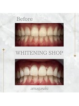 ホワイトニングショップ 尼崎店/セルフホワイトニング1回の効果