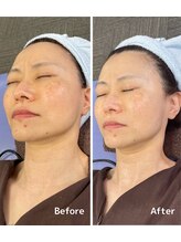 おおむら鍼灸接骨院/フェイシャル Before＆After