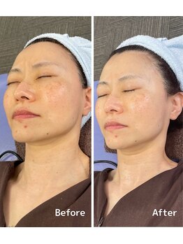 おおむら鍼灸接骨院/フェイシャル Before＆After