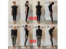 ガロシェ(galocher)/反り腰で顎が上がり、首痛