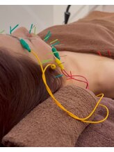 トイ鍼灸接骨院(TOY鍼灸接骨院)/●美容鍼灸