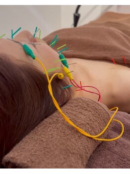 トイ鍼灸接骨院(TOY鍼灸接骨院)/●美容鍼灸