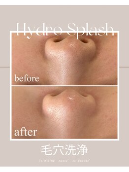 ジュメーム サンテ エ ボーテ(Je m'aime sante' et beaute')/ハイドロ毛穴洗浄