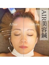 ラピスラズリ(Lapis Lazuli)/ノンニードル美容