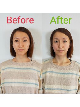 シャルム(Charme)/小顔矯正1回