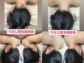 るあん/うなじ脱毛Before&After