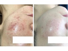 スリリアン 銀座の雰囲気（【とことん結果を出す】ニキビ毛穴徹底ケアで美肌を叶える/銀座）