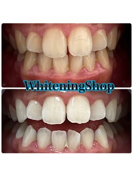 ホワイトニングショップ 山形店(Whiteningshop)/食事制限無し！