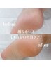 フット】削らない！？１５分の新しい角質ケアで足裏美人♪