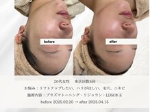 エメ 名古屋栄店(aimer)/LiftCare <小顔・リフトアップ>