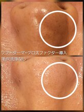 ベリー(Berry)/ソフトダーマ